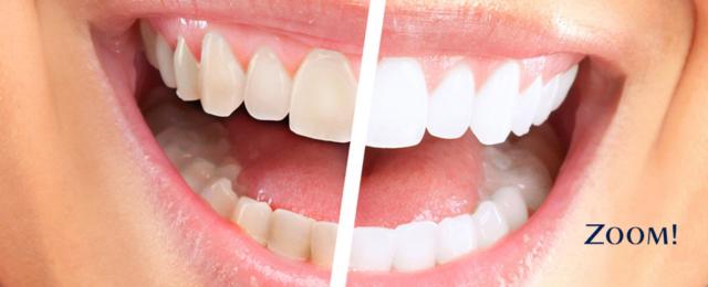 1358915840_475354133_2-Fotos-de--Ortodoncia-Invisible-Blanqueamiento-Dental.jpg